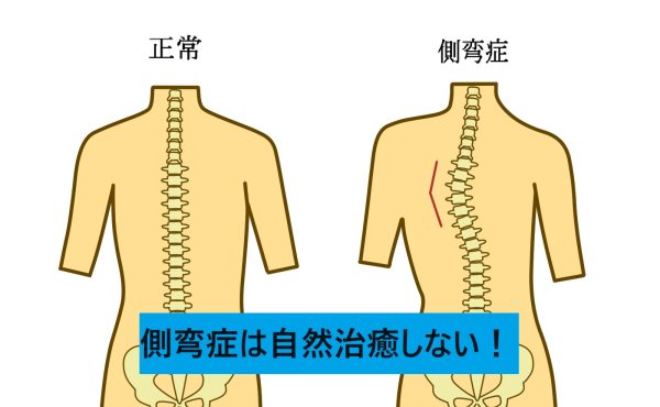 姿勢がおかしい？それは側弯症かも